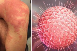 O que é Herpes-zóster - Por que os casos aumentaram 200% no Brasil