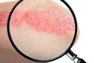 29 de outubro - Dia Mundial de Combate à Psoríase