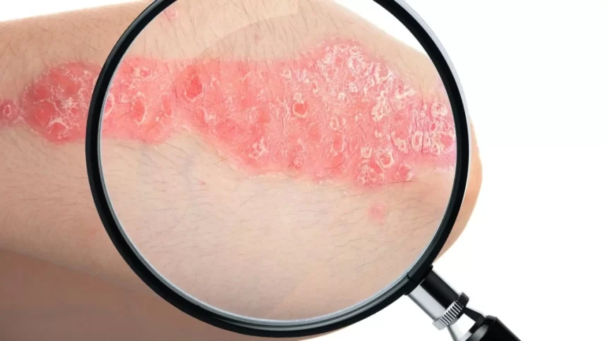 29 de outubro - Dia Mundial de Combate à Psoríase