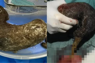 Criança passa por cirurgia para remover enorme bola de cabelo do estômago