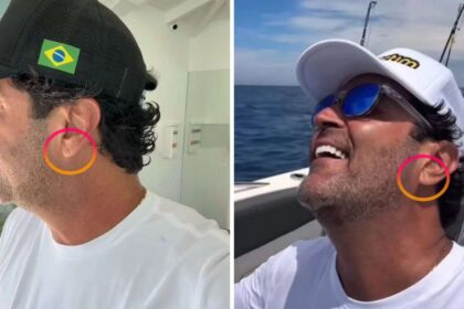 Sinal de Fran - uma pequena marca na orelha pode indicar problemas cardíacos