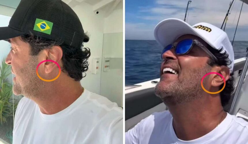 Sinal de Fran - uma pequena marca na orelha pode indicar problemas cardíacos