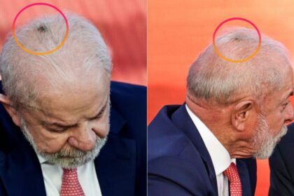 Lula remove lesão no couro cabeludo e diagnóstico aponta câncer basocelular