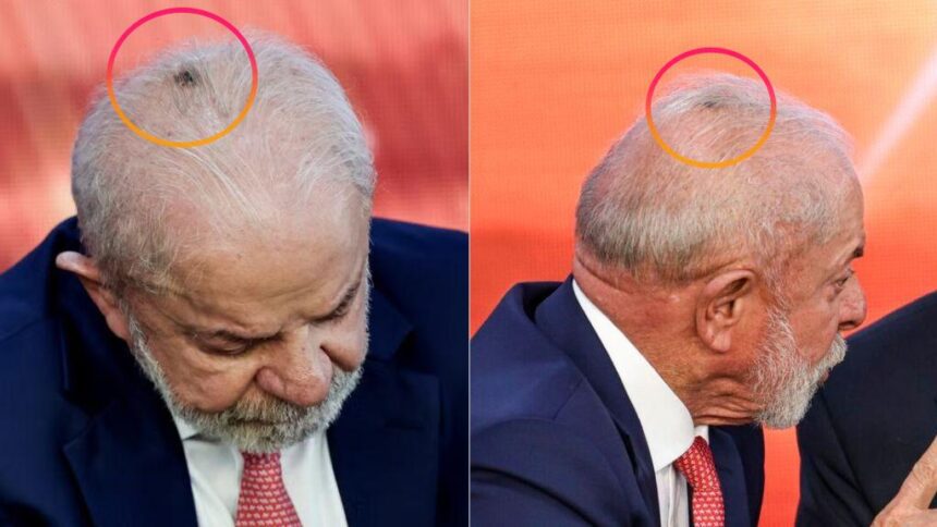 Lula remove lesão no couro cabeludo e diagnóstico aponta câncer basocelular